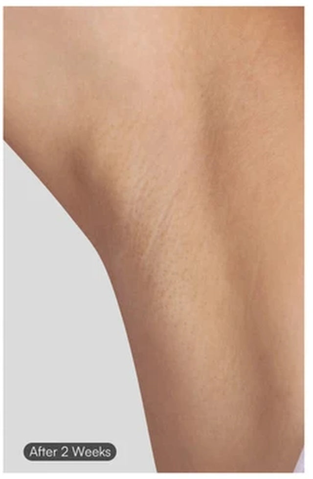 Skin after completing the 12-week Hyper Sunk IPL protocol