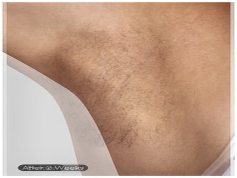 Underarm — Week 6
