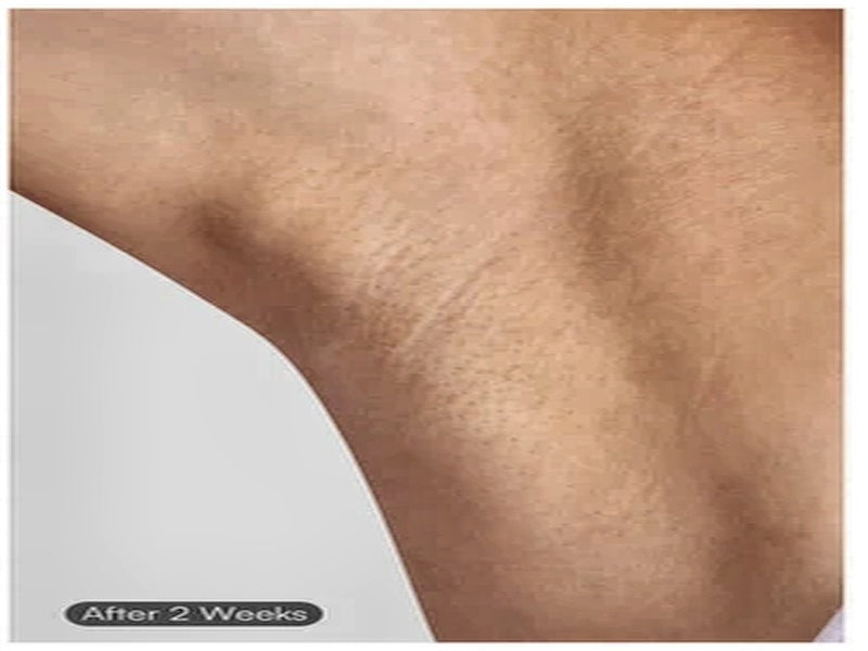 Weeks 5-8 Permanent After